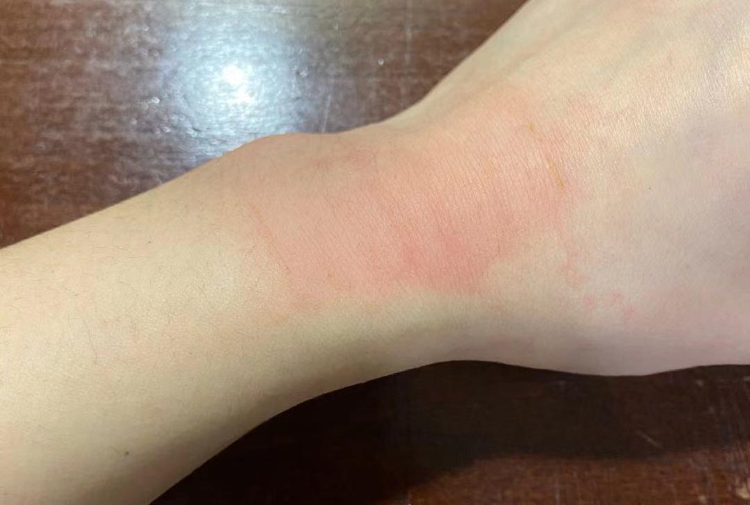 哪里痛就贴哪里？膏药这样贴效果才好！但这些人千万慎用