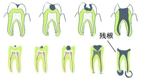 吃饭咬到嘴了是因为想吃肉,吃饭咬到舌头是馋肉吗