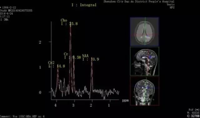核磁共振能看出来哪些病症,核磁共振可以检查良恶性吗