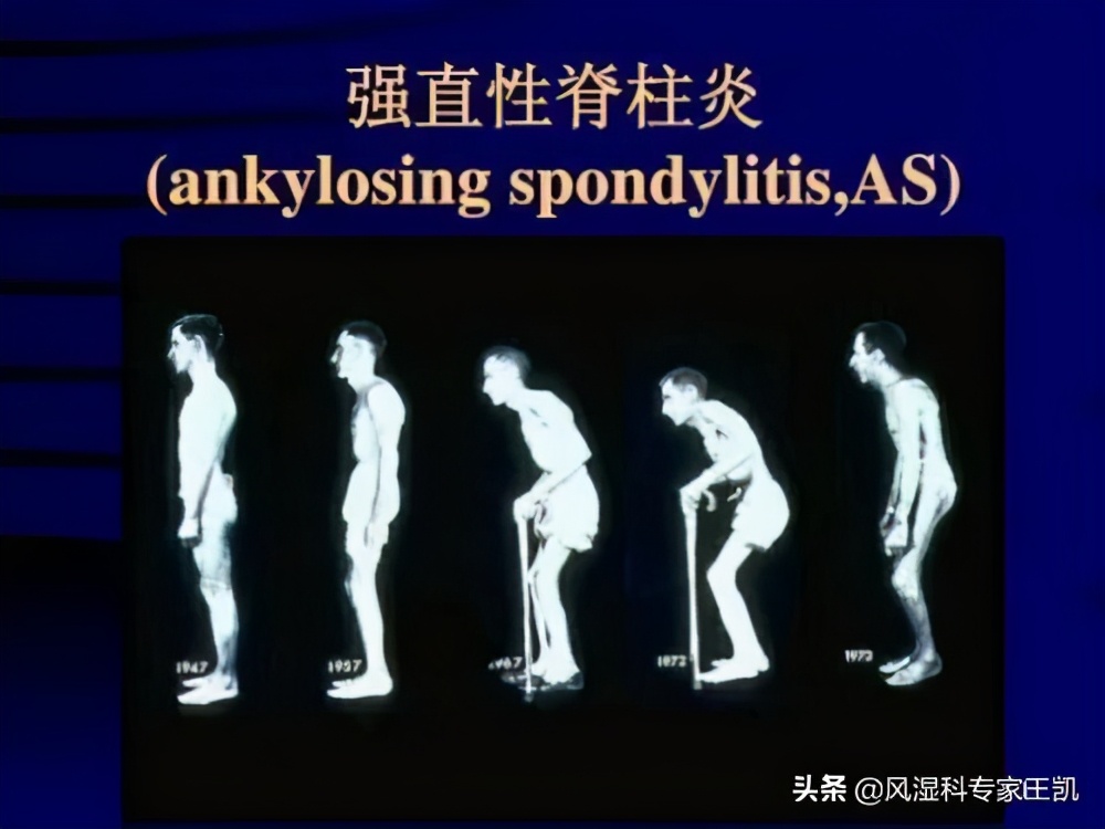 类风湿关节炎的先兆,类风湿关节炎能治愈吗