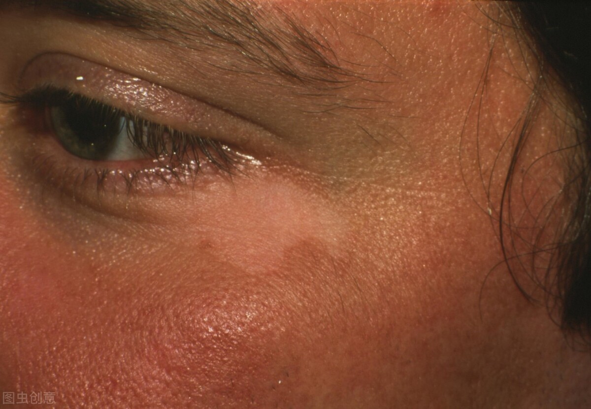 肚子上有白癜风怎么治疗,腹部白癜风