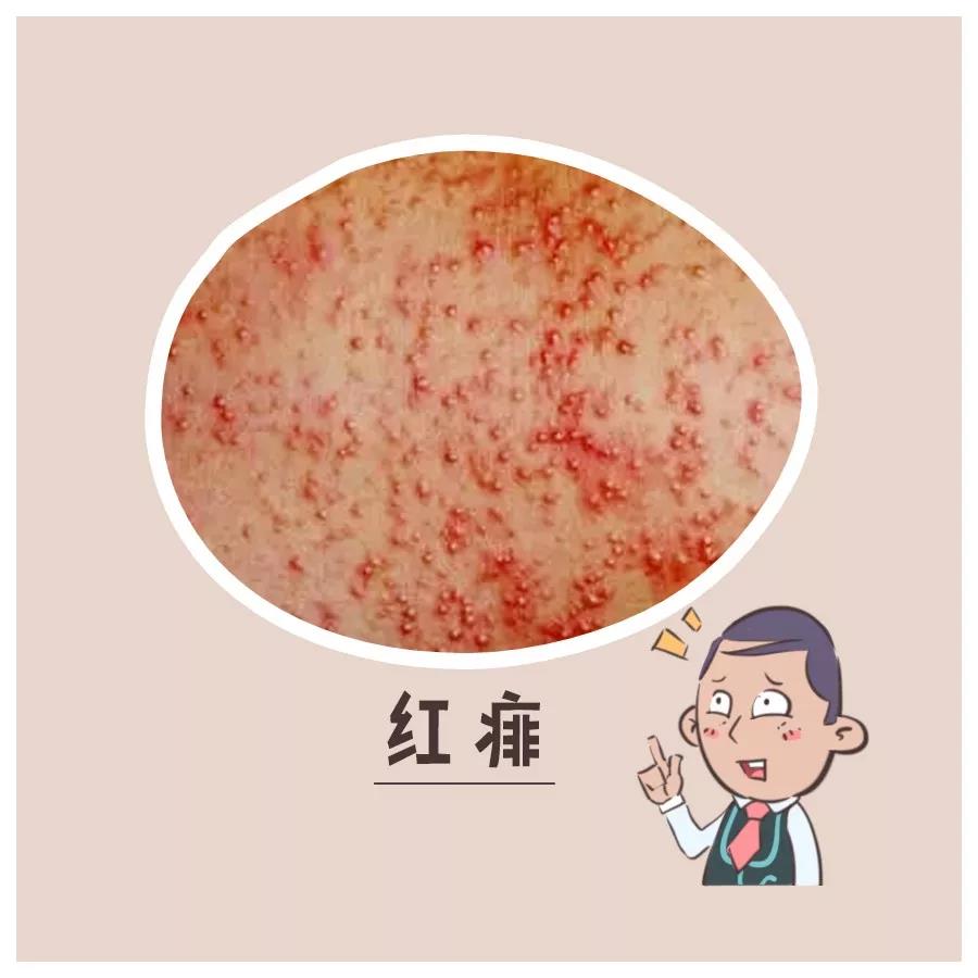 天热起痱子怎么能去根,天热痱子用什么药材治呢