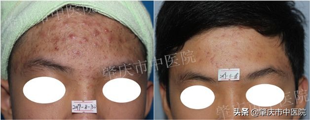 油痘皮如何拯救?get这份“刷酸焕肤”攻略,让皮肤细腻光滑!