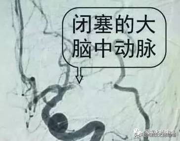 如何让身体不形成血栓,一个动作让血栓变好