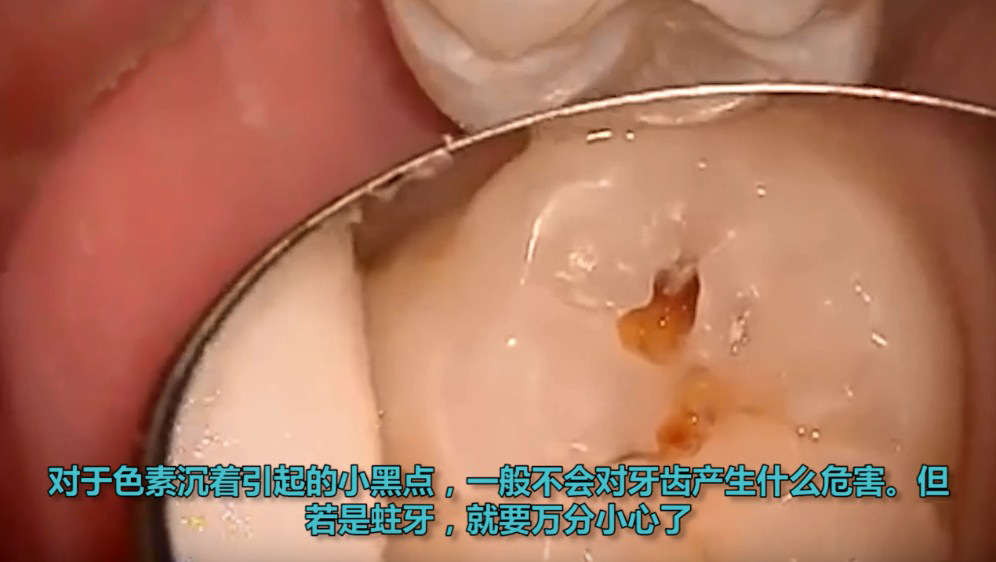 牙齿表面有小黑点内部一定坏了吗,根管治疗后牙齿有小黑点