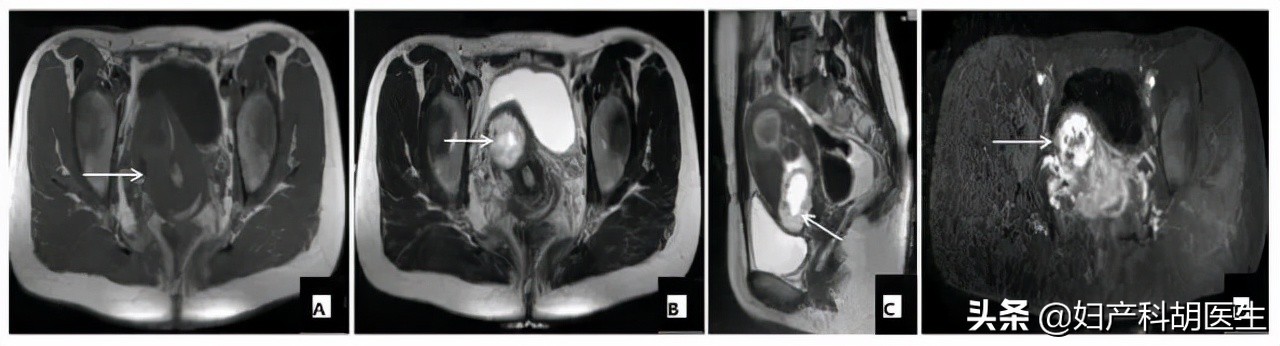 人工流产真实例子,人工流产的悲催案例