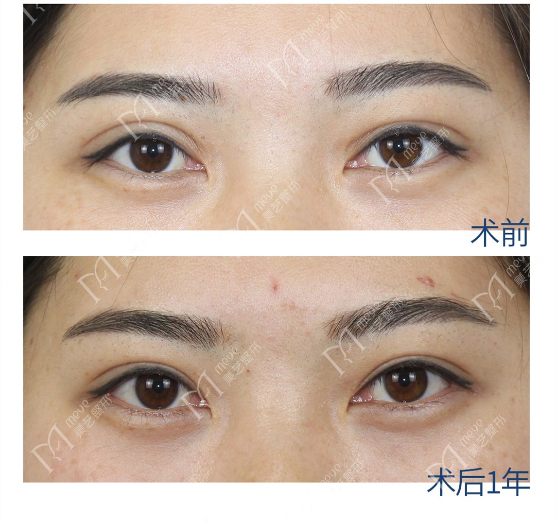 双眼皮术后出现肉条怎么办,双眼皮肉条感修复手术痛吗