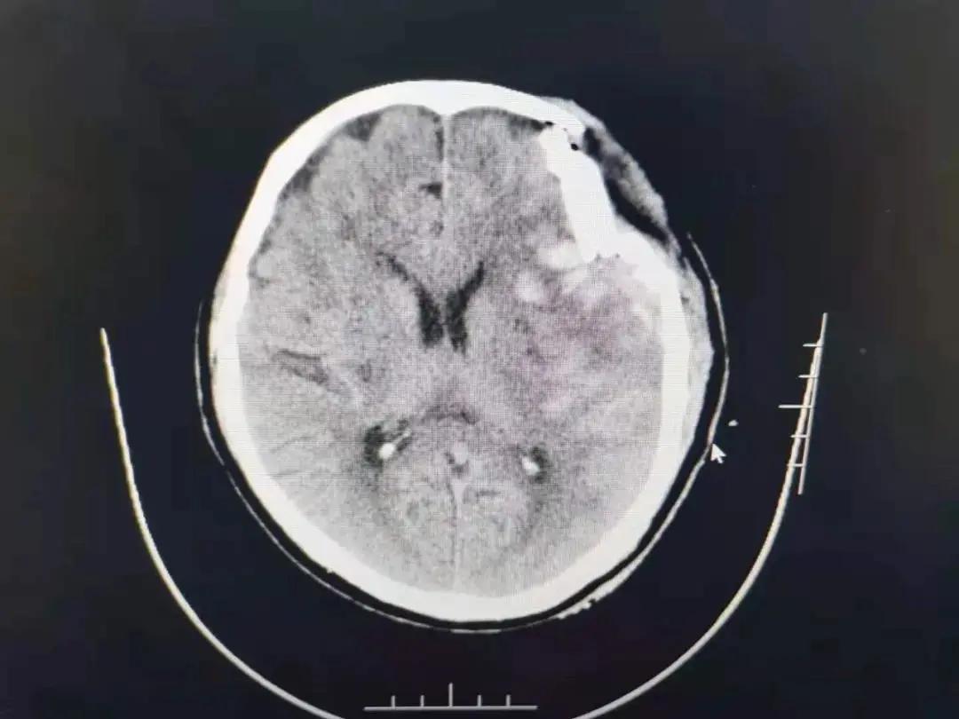 脑损伤新突破,重度颅脑损伤急救