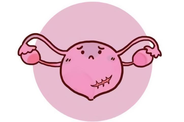 疾病科普子宫畸形如何治疗,一个正常的子宫有哪些症状