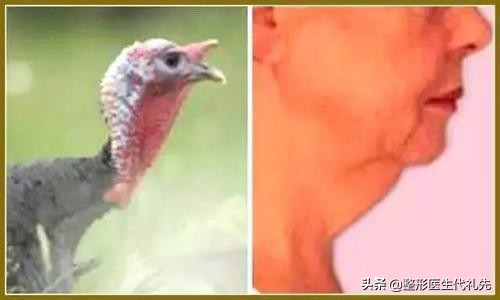 咨询医生怎样去除皱纹,医生讲颈纹怎么消除的小妙招