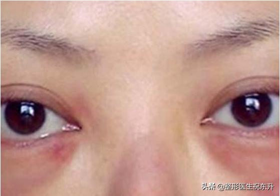 眼袋外切14天睑外翻多久可以恢复,外切眼袋如何避免下睑外翻
