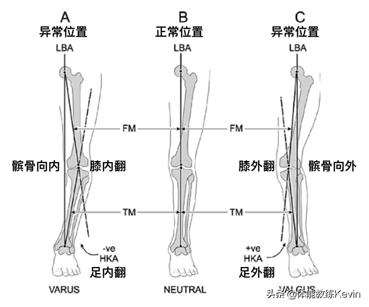 千里之行，始于“足下”——足外翻的5种解决方法
