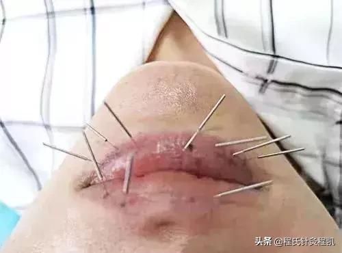 祛痘咨询科普,祛痘咨询中医调理