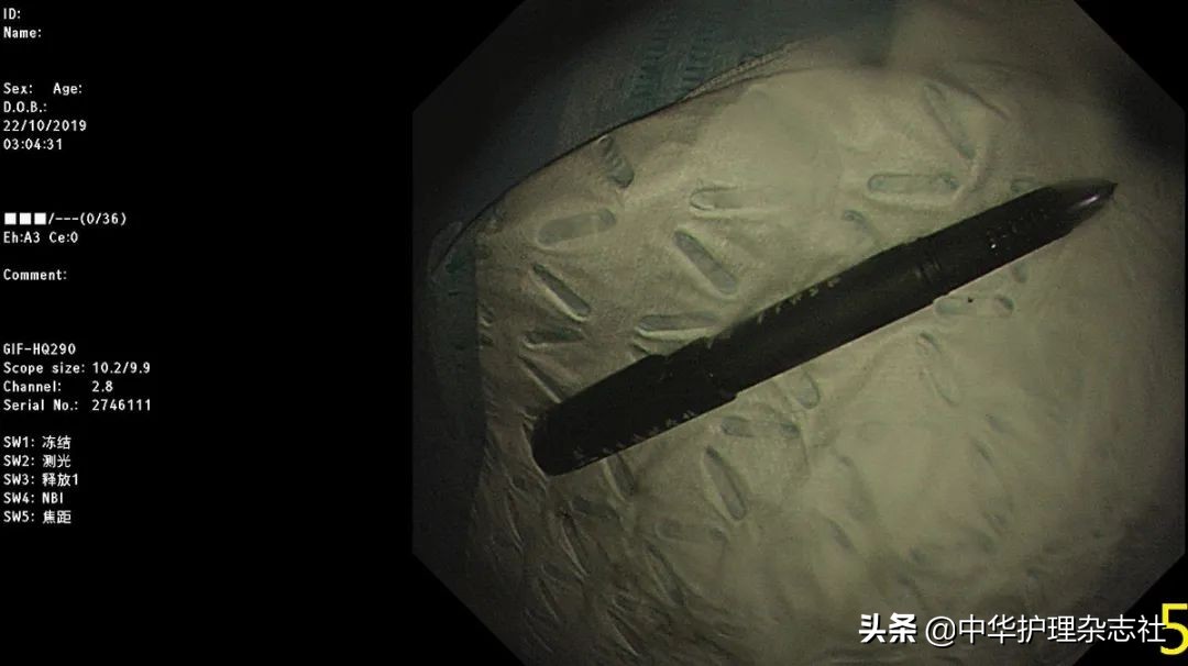 误吸患者护理的应急预案,幼童误吞电池医生顺利取出