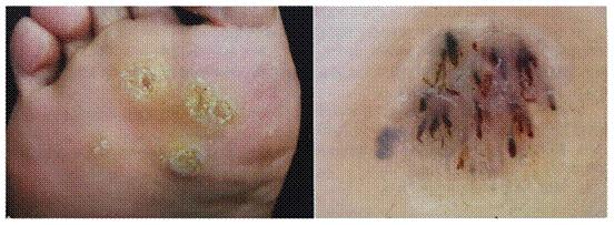 脚上长了一个类似鸡眼但不是鸡眼,脚上长了类似鸡眼是什么