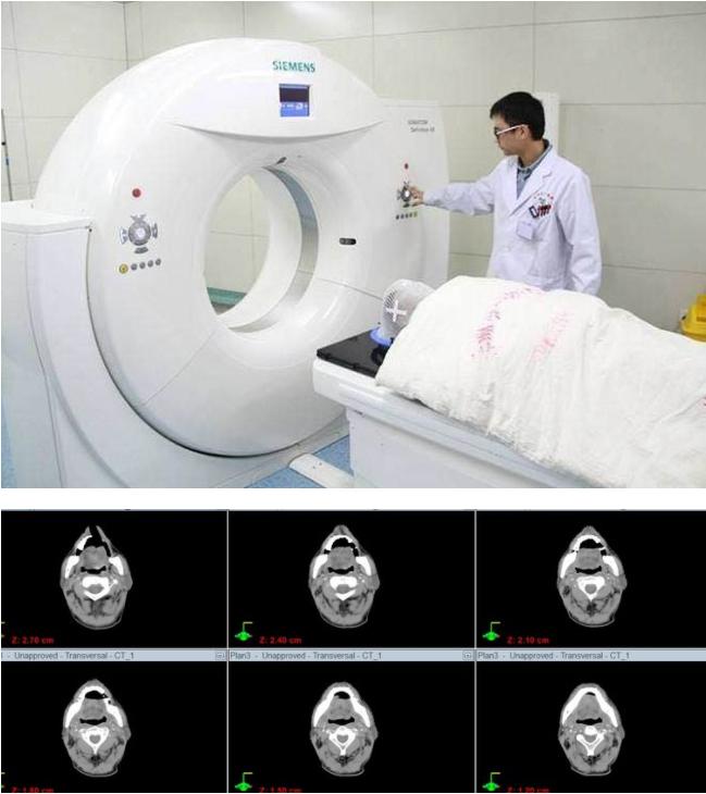 一期癌症放射治疗治愈率,放射治疗是姑息还是根治
