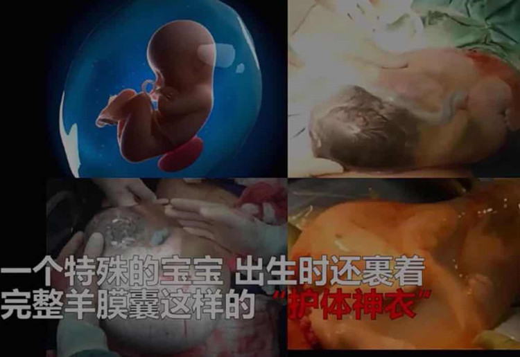 孩子出生的时候裹着羊膜囊怎么办,女婴连体衣护肚子