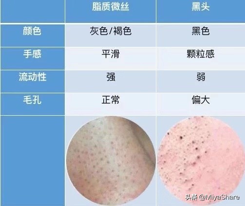 改善黑头和去黑头有什么区别,黑头用黑头膏为什么去不掉黑头