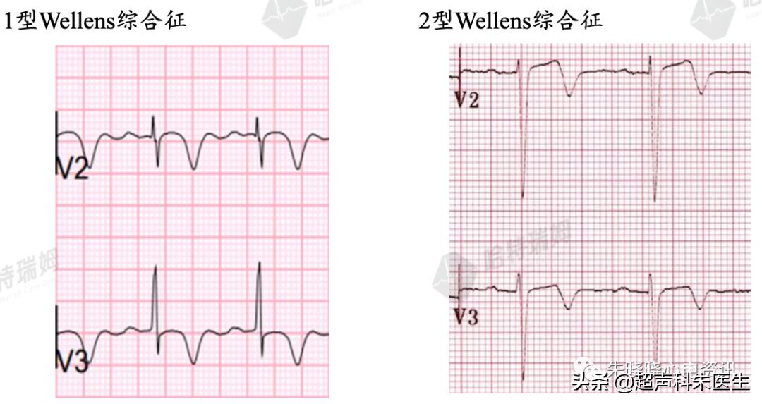 t波倒置诊断,t波倒置如何区分严重程度