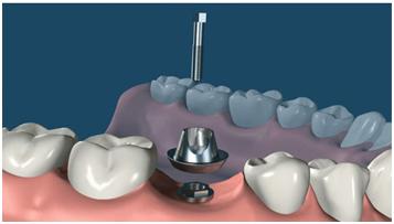 种植牙手术一期与二期谁更痛苦,种植牙手术到底能有什么风险呢