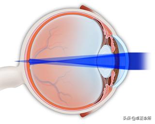 怎么按摩眼睛改善散光,怎么锻炼眼睛能改善散光