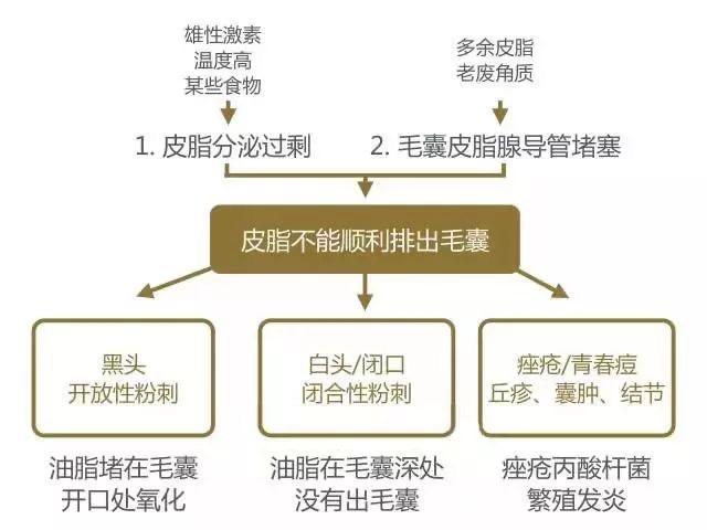 挤闭口粉刺有效吗,挤下巴闭口粉刺