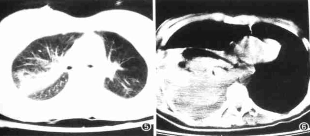56岁男性发现双肺数百个结节,肺部肿块伴胸腔积液
