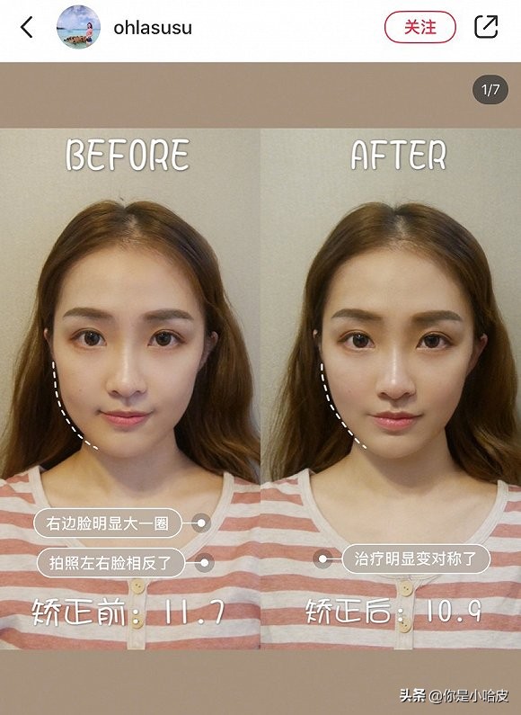 日式小颜整骨是真的假的,不动刀脸部轮廓整形多少钱