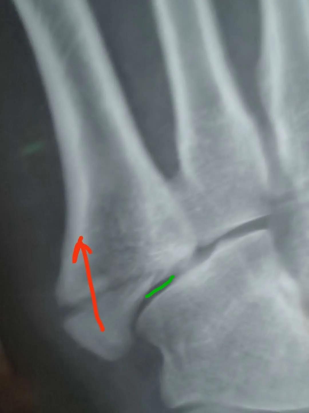 第五跖骨粉碎性骨折多久后能走路,第五跖骨基底骨折100天了走路肿