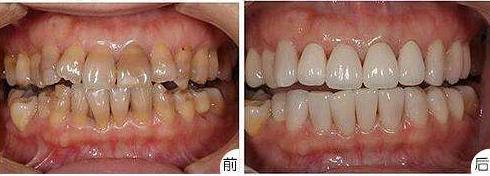 美牙冠改善龅牙,美牙冠可以修复缝隙吗