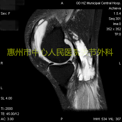 关节炎的病理知识,关节炎科普视频
