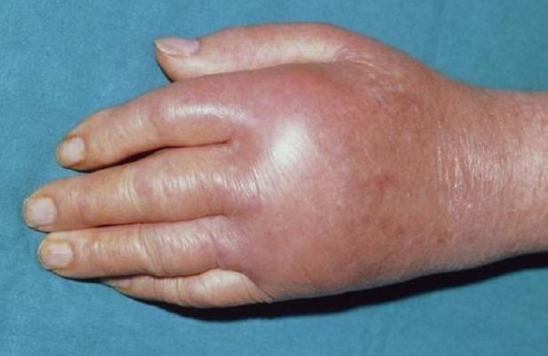 痛风发作期为什么走走症状会减轻,痛风发作期用什么药有效缓解症状