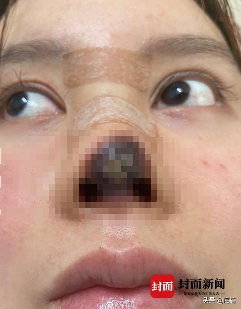 演员高溜整容失败鼻子坏死,演员高溜整容鼻子坏死