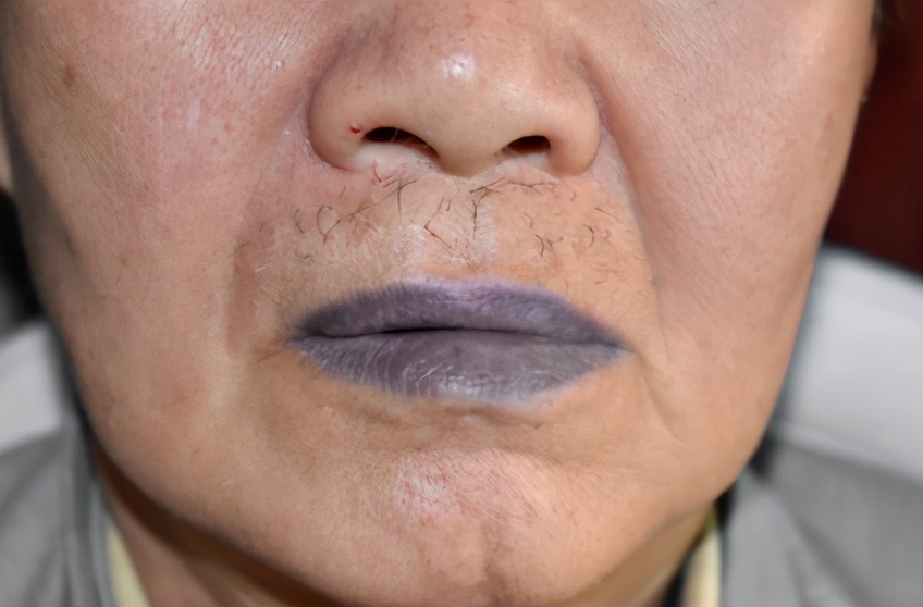 嘴唇有黑痣一定肠道息肉吗,嘴唇上长黑斑与肠息肉