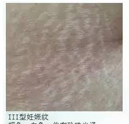 如何消除妊娠纹有效而且彻底,怎样消除妊娠纹的方法最快最有效