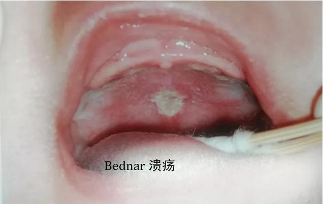 7岁宝宝嘴唇溃疡一大片，原因竟然是这个！#雅悦齿科#