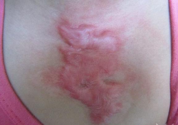 怎么治疗烧伤疤痕增生,烧伤疤痕的增生期是多久