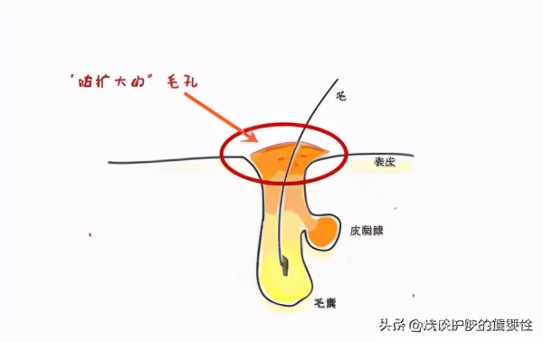 鼻子的毛孔粗大怎么缩小毛孔,鼻子毛孔挤出黑头后如何收缩毛孔