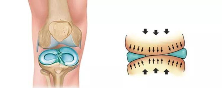 打篮球预防半月板损伤,半月板损伤治疗预防药物