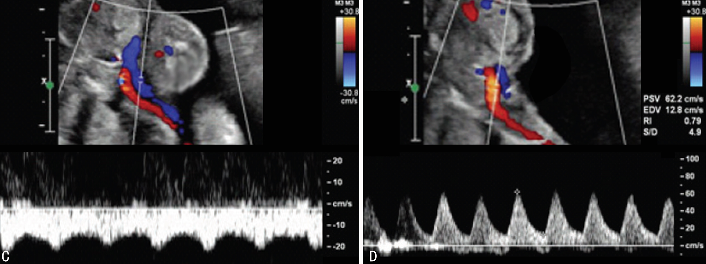 多胎妊娠超声早期图像,2个月怀孕彩色超声诊断报告单