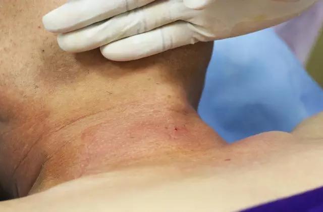 甲状腺结节频发，该拿它怎么办才好？