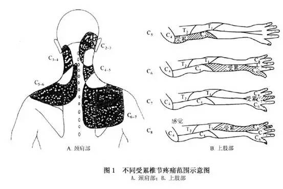 神经根型颈椎病保守治疗效果好吗,神经根型颈椎病保守治疗效果