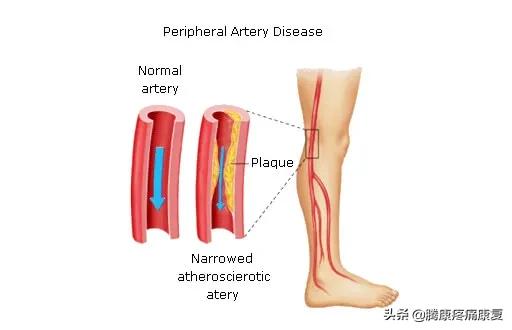 老人小腿疼痛是什么原因,小腿疼痛是什么原因引起的