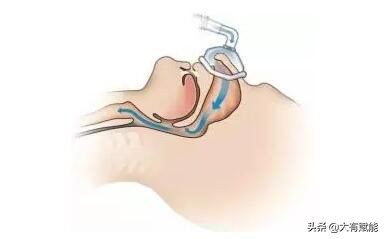 睡眠呼吸暂停监测全过程视频,深度解析呼吸暂停