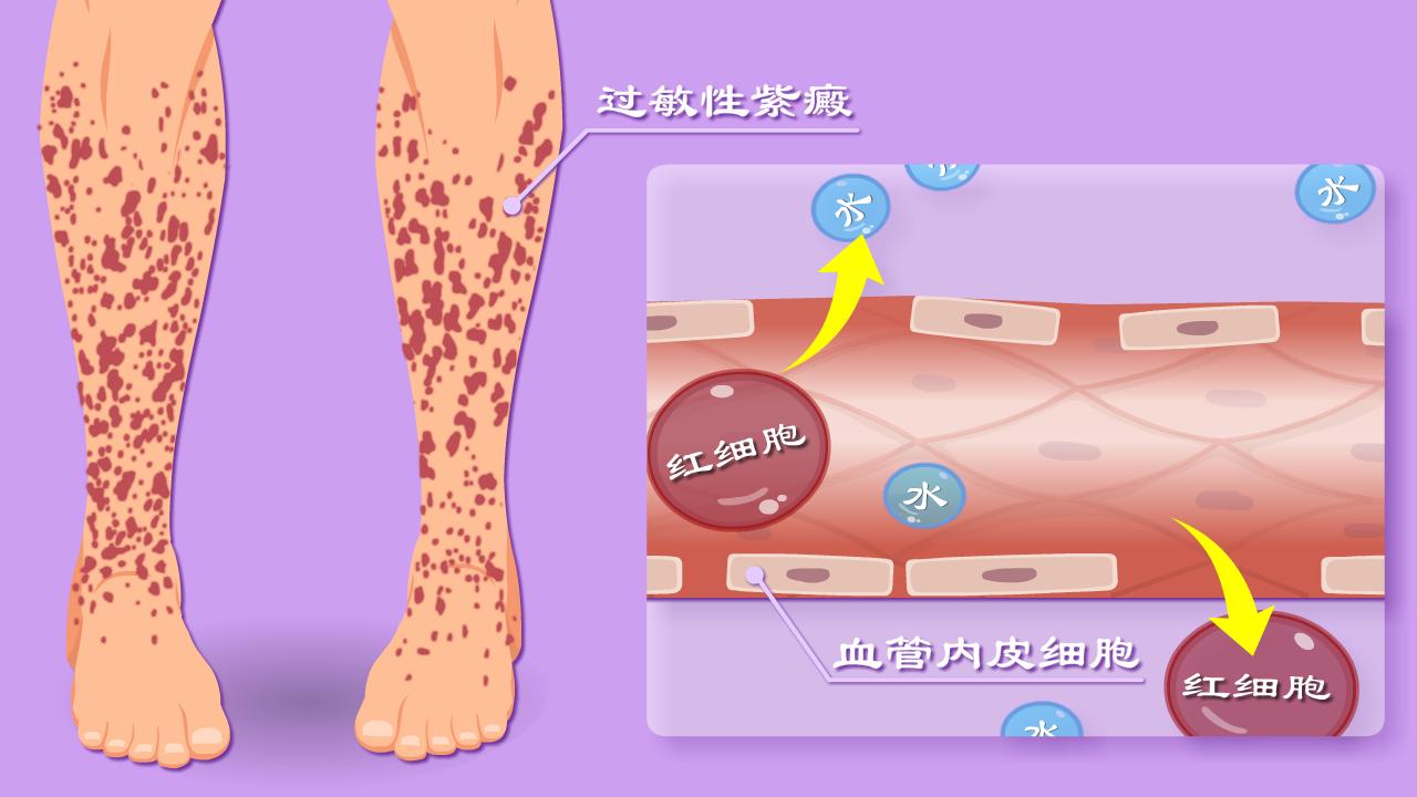 肾性过敏性紫癜多久出现血尿,肾型过敏性紫癜出现血尿时间