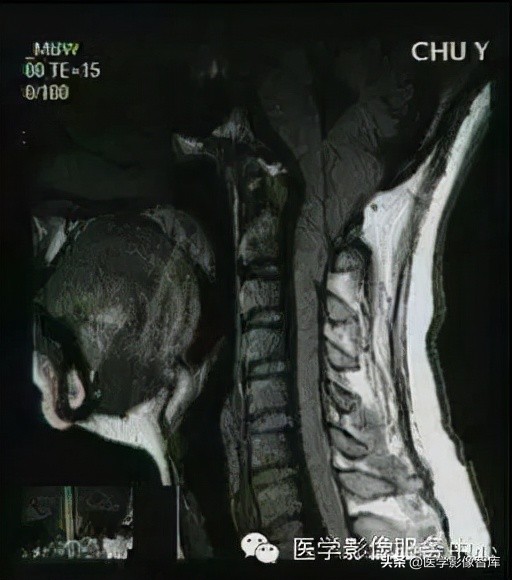 chiari畸形确诊,chiari畸形症状会一直有吗