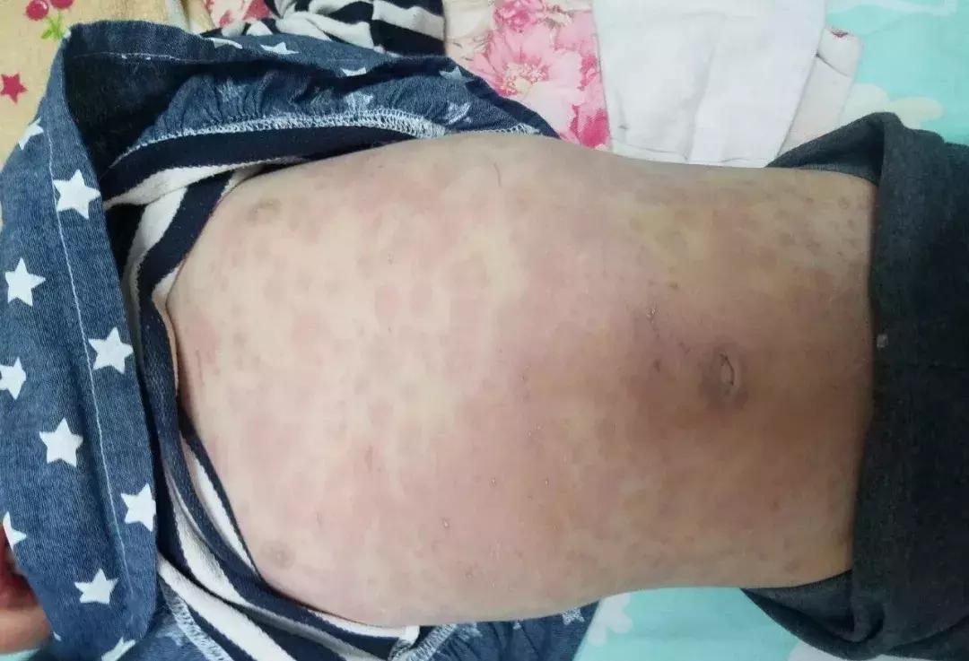 孩子扁桃体发炎连续三天高烧不退,老人连续几天高烧不退怀疑什么病