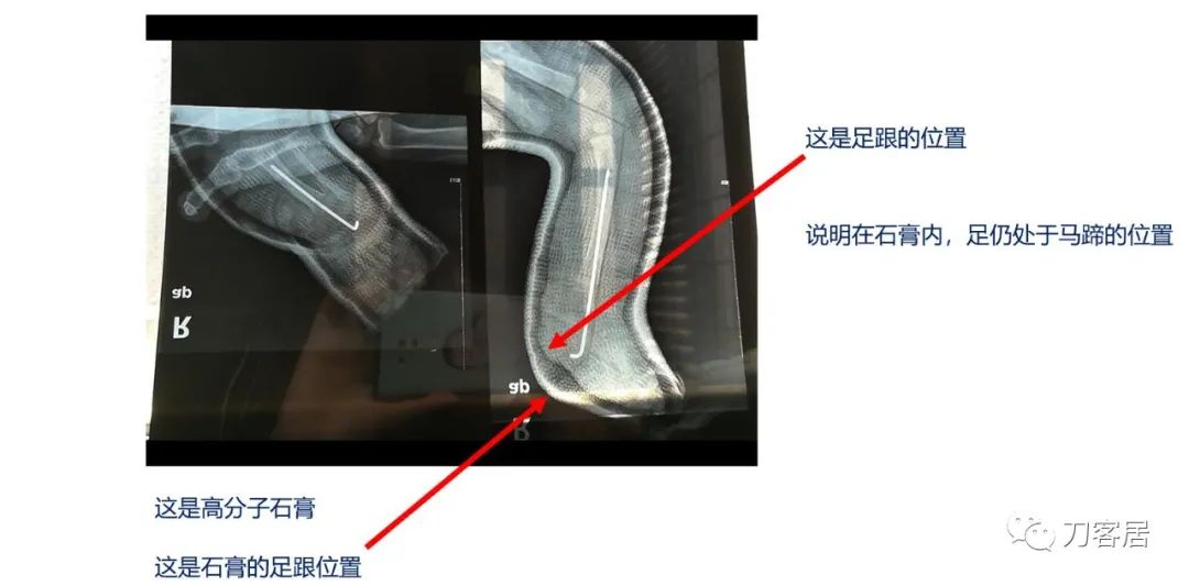 一个脊柱外科医生与马蹄内翻足的纠缠-写在6.3国际马蹄内翻足日前