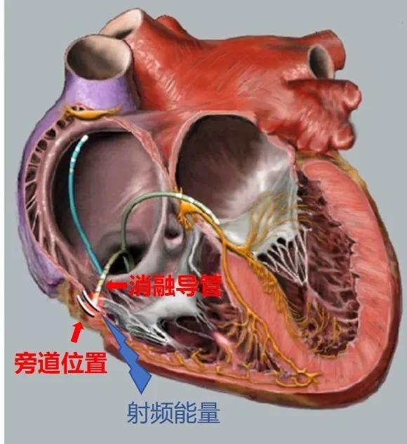 得了预激综合征严重吗,为什么会得预激综合征