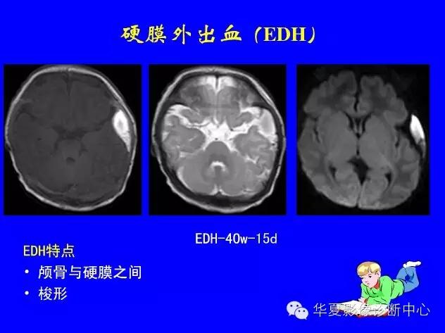 新生儿颅脑mri,新生儿颅脑mr报告模板